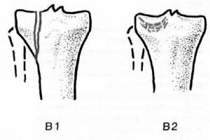 Признаки и методы лечения переломов мыщелков большеберцовой кости Перелом внутреннего мыщелка большеберцовой кости без смещения