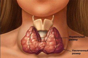 Причины, симптомы, степени и лечение увеличения щитовидной железы